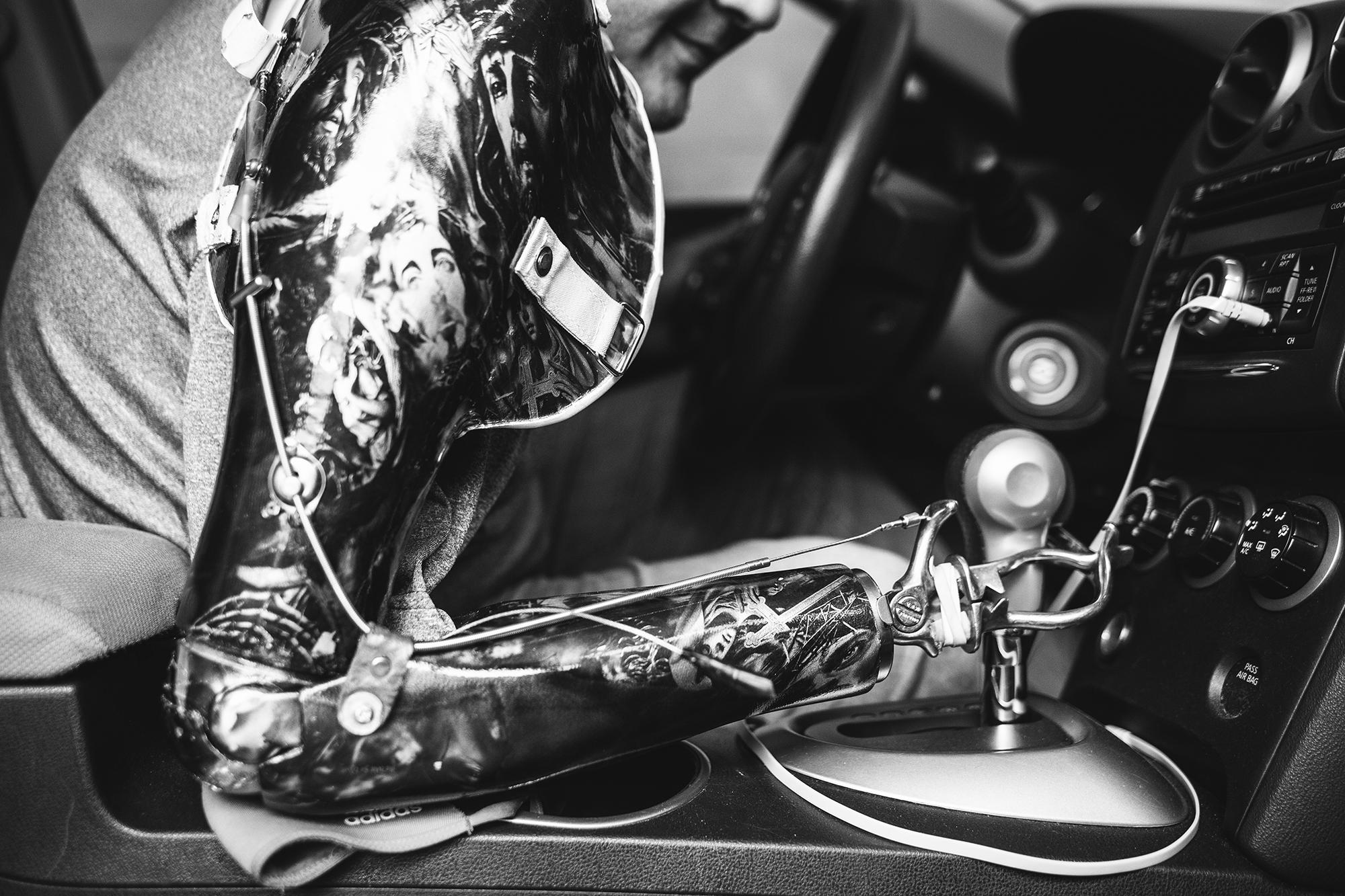 Debido al accidente, la amputación que se le realizó a Eduardo fue desde el hombro, y la prótesis que debe usar es de un brazo completo. La persona culpable del accidente contaba con un seguro que le permitió comprar una prótesis avanzada para Eduardo.
