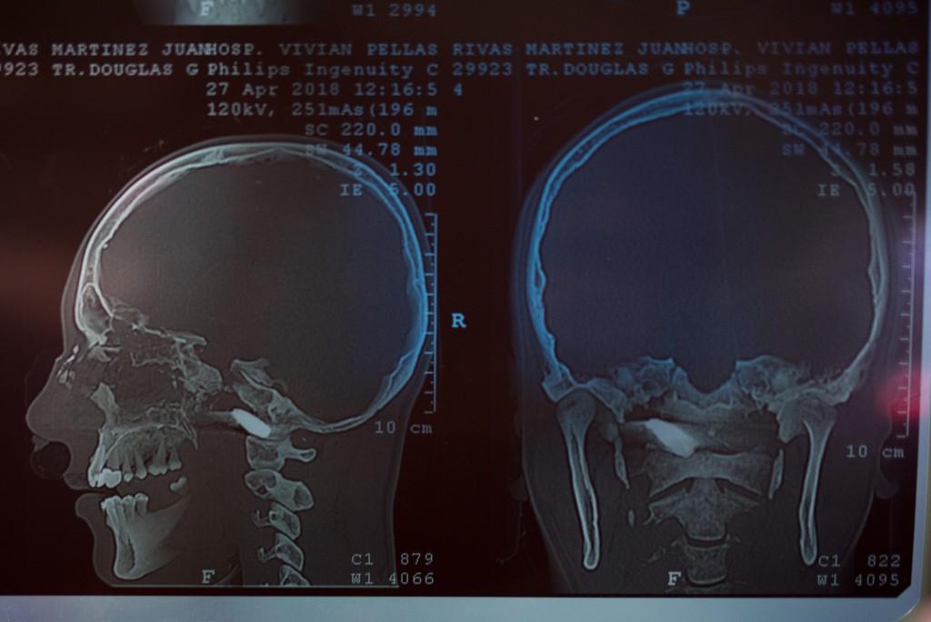 Los familiares de Juan Bosco Rivas Martínez muestran las radiografías que le realizaron en el hospital Vivian Pellas. La bala no pudo ser extraída de la cabeza de la víctima. Foto: Carlos Herrera, Confidencial.