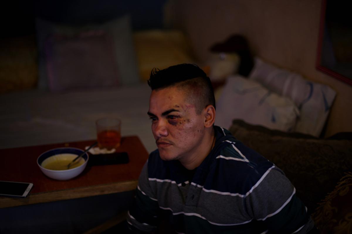 Alex Peña relata como fue golpeado por los agentes de la PNC de la subdelegación de Ciudad Delgado, San Salvador. Foto: Fred Ramos