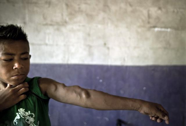 Arturo José Guardado, de 17 años y oriundo de San Luis Talpa, muestra las marcas que los catéteres han dejado en su brazo. Le diagnosticaron insuficiencia renal crónica cuando tenía 11 años. Foto José Cabezas (AFP)﻿.