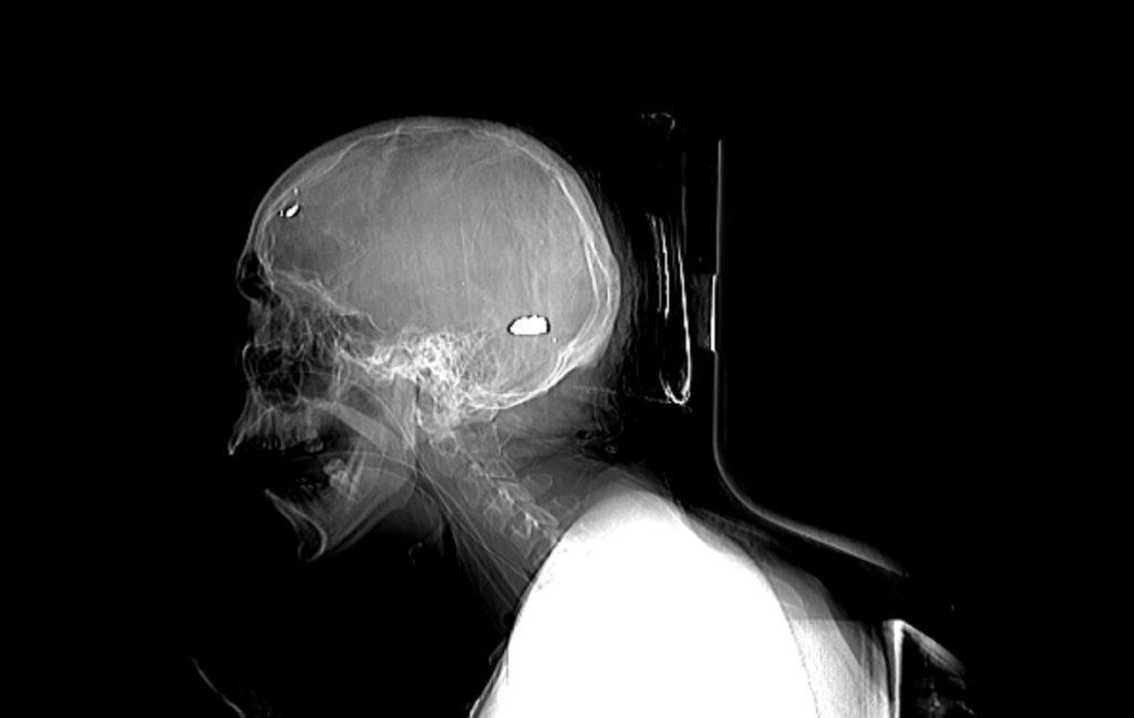 Disparo con trayectoria de arriba hacia abajo. Ingresó en la frontal-derecho hacia la región parieto-occipital. El proyectil de AK quedó alojado en la línea media del cerebro. Foto: Confidencial.