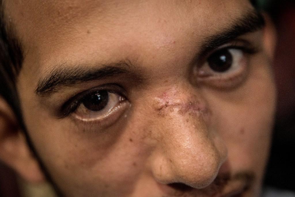 Juan Bosco Rivas Martínez muestra la cicatriz que le dejó la bala de AK que perforó su rostro. Foto: Carlos Herrera, Confidencial.