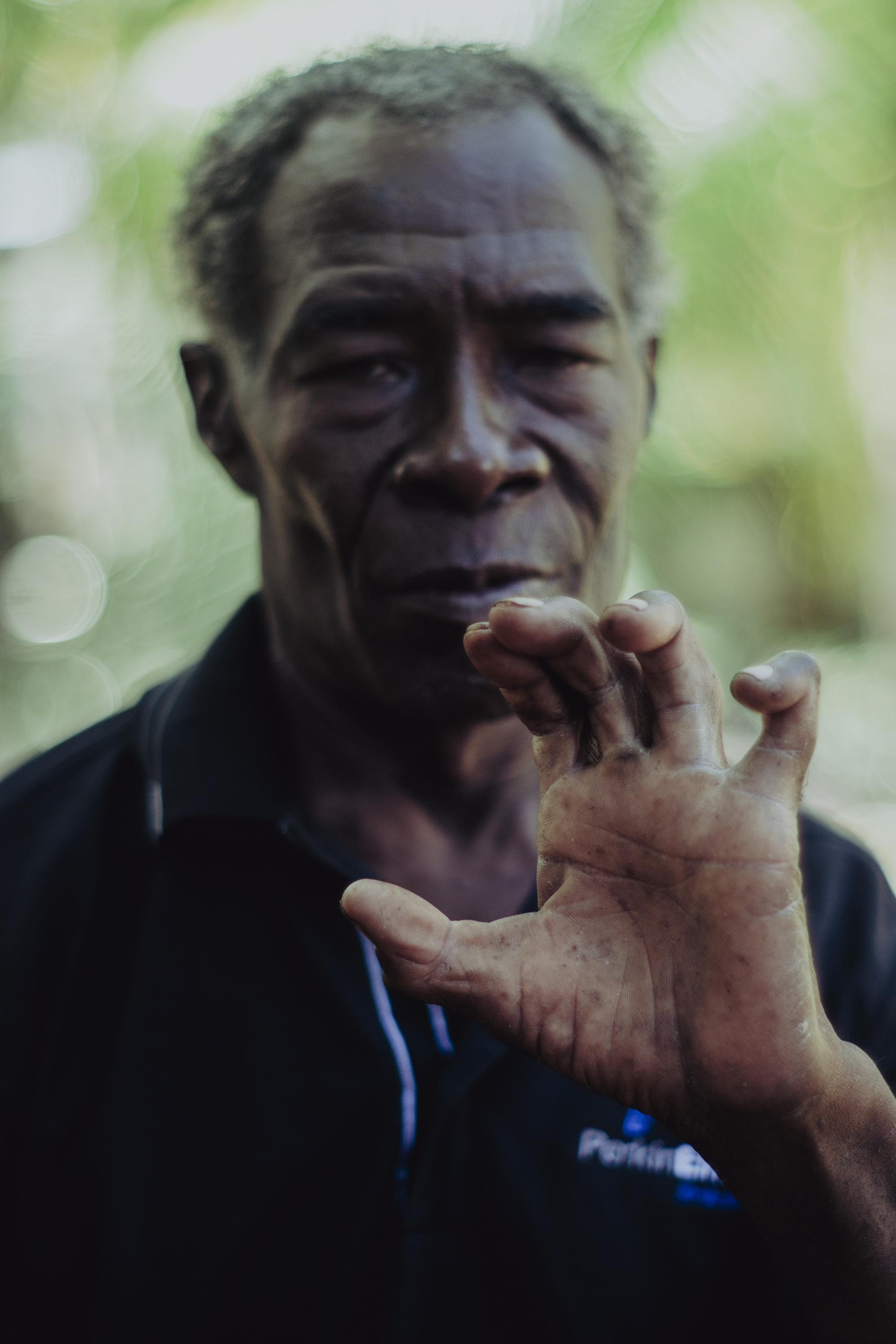 Jesús Flores’ fingers were paralyzed when he was shot by the Honduran Coast Guard during an expedition in an area where his family has fished for decades. Photo: Carlos Barrera/El Faro