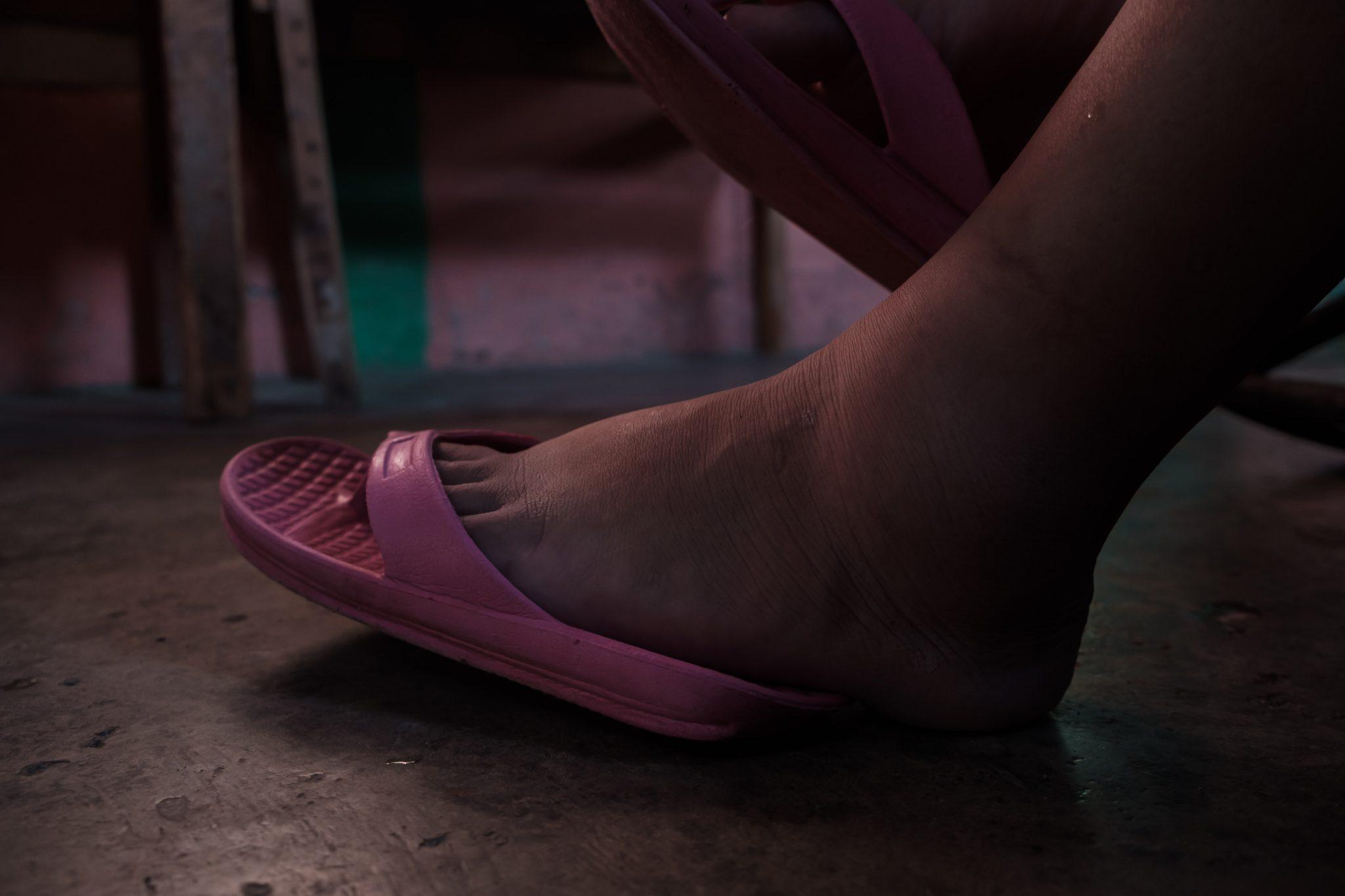Cindy’s swollen ankle, sprained while trying to escape the tear gas. Photo:  Deiby Yánes /Contracorriente