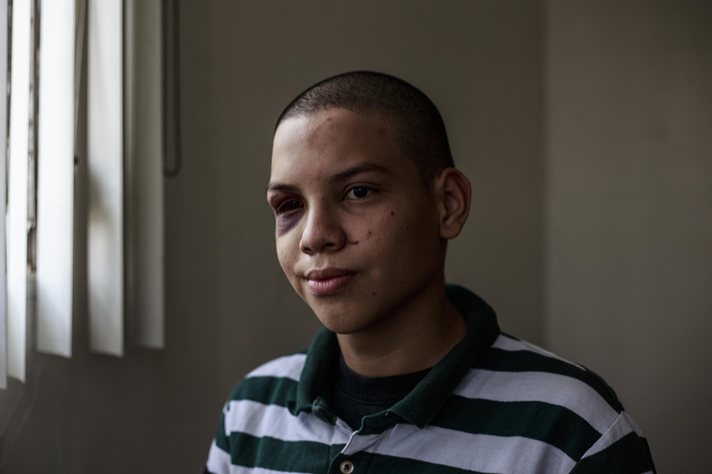 José Alexander Bermúdez, law student at the National Autonomous University of Nicaragua. On Saturday, April 21, 2018, the first day of protests against reforms to the Nicaraguan Social Security Institute, he was walking home in Managua when police detained and assaulted him. He was detained in El Chipote Prison, where he says he was tortured. Photo: Fred Ramos/El Faro