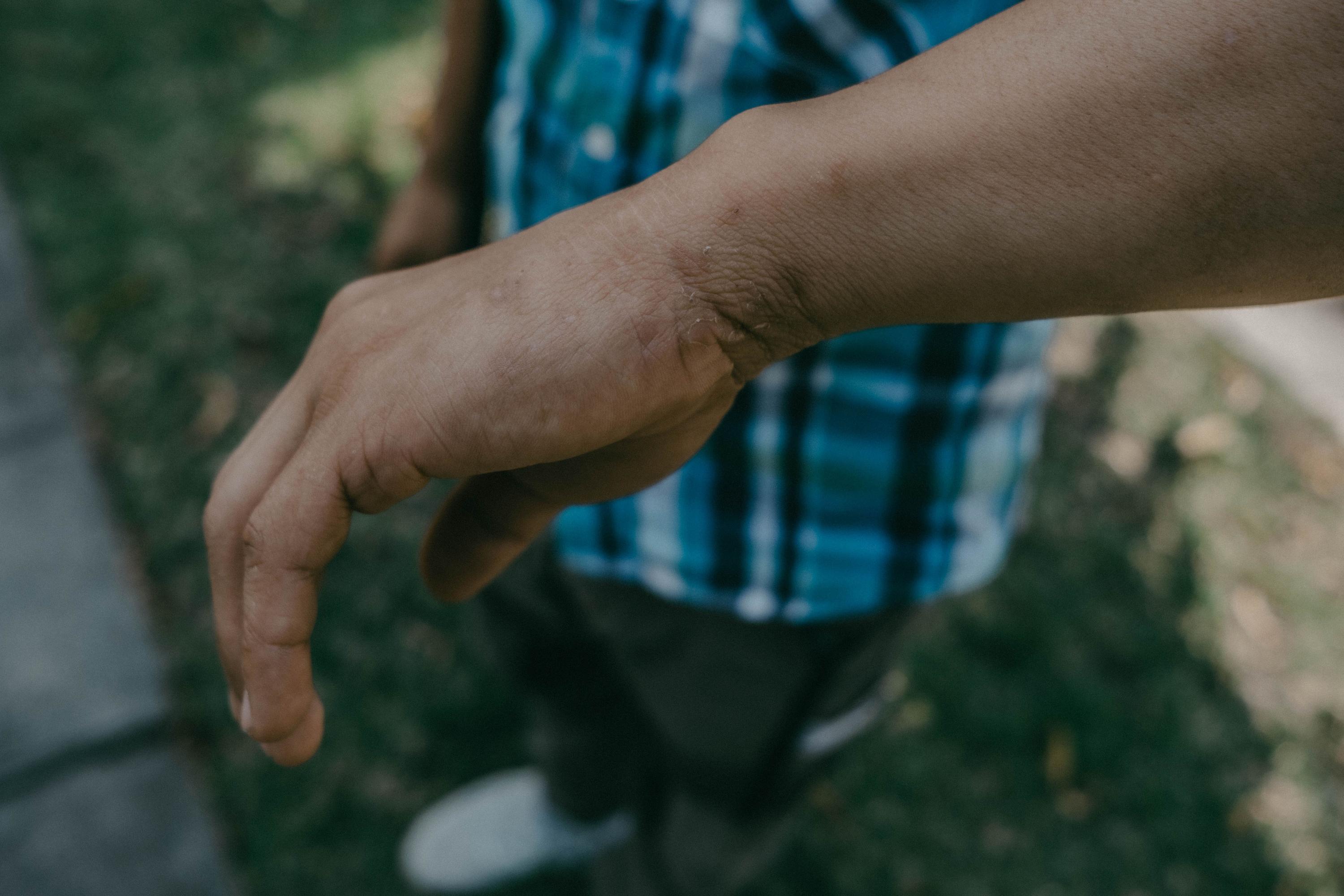Ramón, víctima de una captura arbitraria, muestra las cicatrices por el contagio de hongos que sufrió durante su encarcelamiento en Mariona. Foto de El Faro: Carlos Barrera